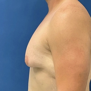 Male Breast Reduction #7 (left)-before