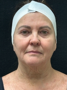 1 syringe of Kysse-before