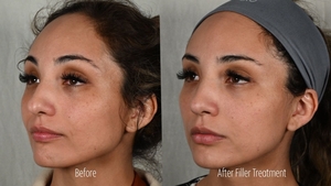 Filler ZB B/A Left Oblique-before