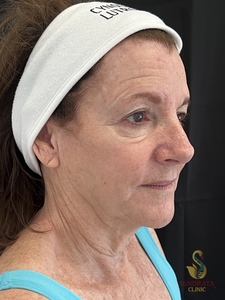 One XERF treatment-before