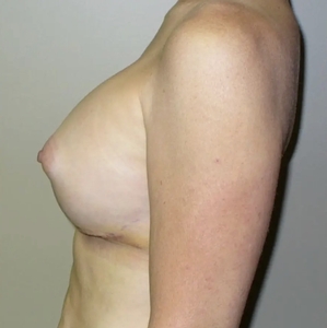 Breast Augmentation #13-after
