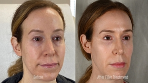 Filler RB B/A Right Oblique-before