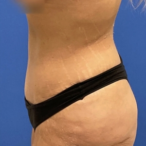 Tummy Tuck #34 (left)-after