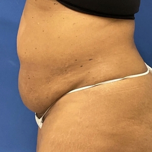 Lipo w Renuvion #6-before