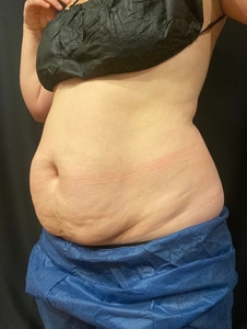 7 Weeks Post 1st CoolSculpting Treatment-before