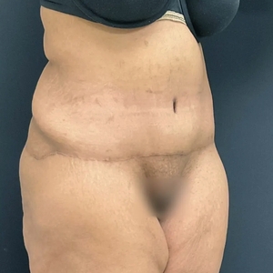 Tummy Tuck #16-after
