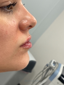 Tori Atkins RN. Volbella-after