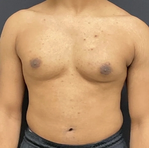 Male Breast Reduction #8-before