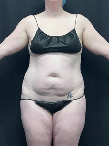 LAL upper+ lower abdomen + mini tummy tuck-before