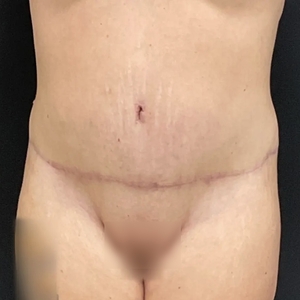 Tummy Tuck #11-after