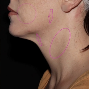 Lipo w Skin Tightening Face #4-after