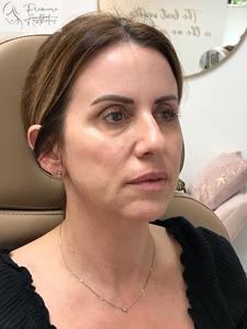 PDO Thread Lower Face Lift-before