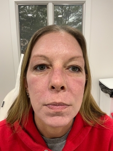 Treatment for acne scarring-after