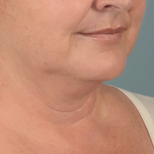 Lipo w Skin Tightening Face #5-before