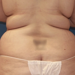 Tummy Tuck #9 (back)-before