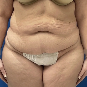 Tummy Tuck #14-before