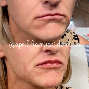 Filler B/A SBA 29-before