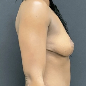 Breast Lift #10-after