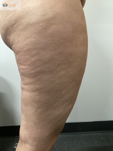 Cellulite reduction-before