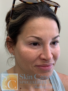 Cheek Filler and Nova Threads Brows-after