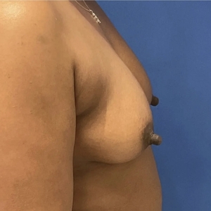 Breast Augmentation #3 400 cc-before