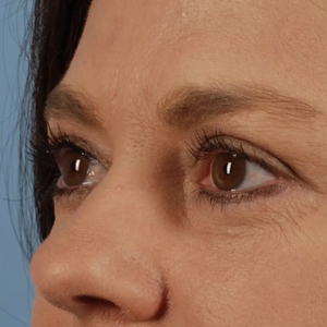 Brow & Eye Lift #5-after