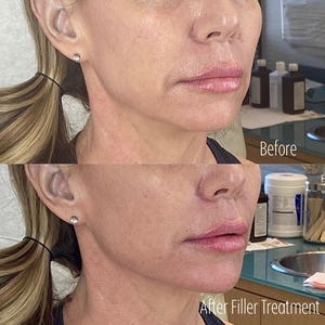 Filler B/A SBA 9-before