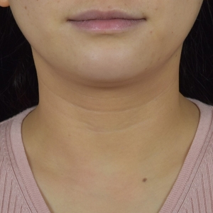Neck Lines-before