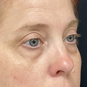 Brow & Eye Lift #4-before
