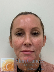 Before and immediately after-after