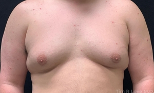 5'7  210# 24 Hour Post Op Bodytite Chest-before