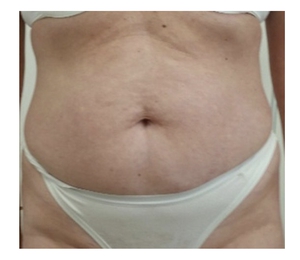 Body Contouring-before