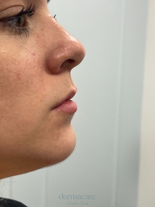 Tori Atkins RN. Volbella-before