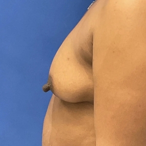 Breast Augmentation #3 400 cc-before