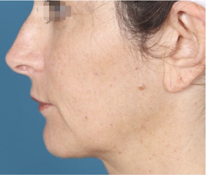 Skin Texture and Laxity-after