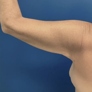 Lipo w Renuvion #4-after