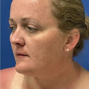 Lipo w Skin Tightening Face #7-before