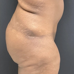 Tummy Tuck #4-after