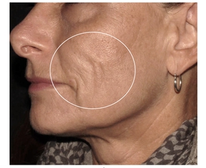 Dermal Thickening-before