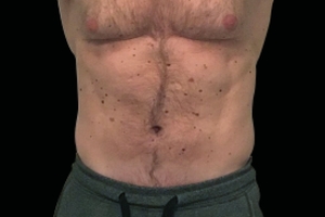 4 Treatments-after