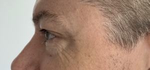 Dry, dehydrated skin-before