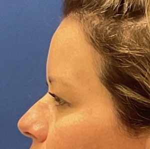 Brow & Eye Lift #2-before