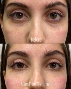 Filler B/A SBA 22-before