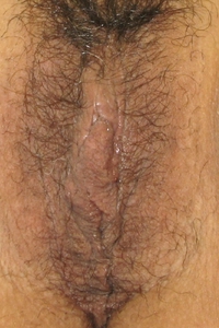 Skin Tightening-after