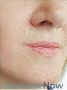 Laser Resurfacing-after