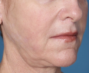 Skin Texture and Laxity-after