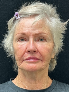 Facial Rejuvenation-after