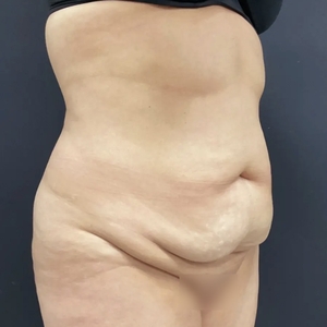 Tummy Tuck #13-before