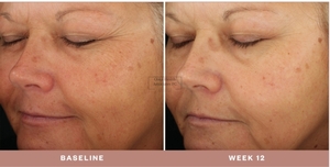 Improved Skin with SkinMedica-before