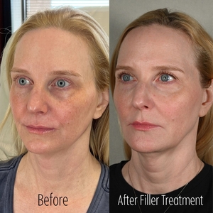 Filler B/A ST Left Oblique-before